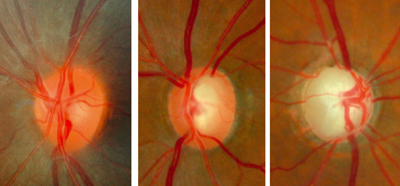 glaucoma image