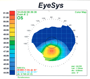 mild keratoconus