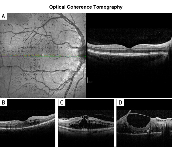 optical-coherence-tomography