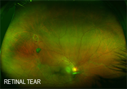 Retinal tear